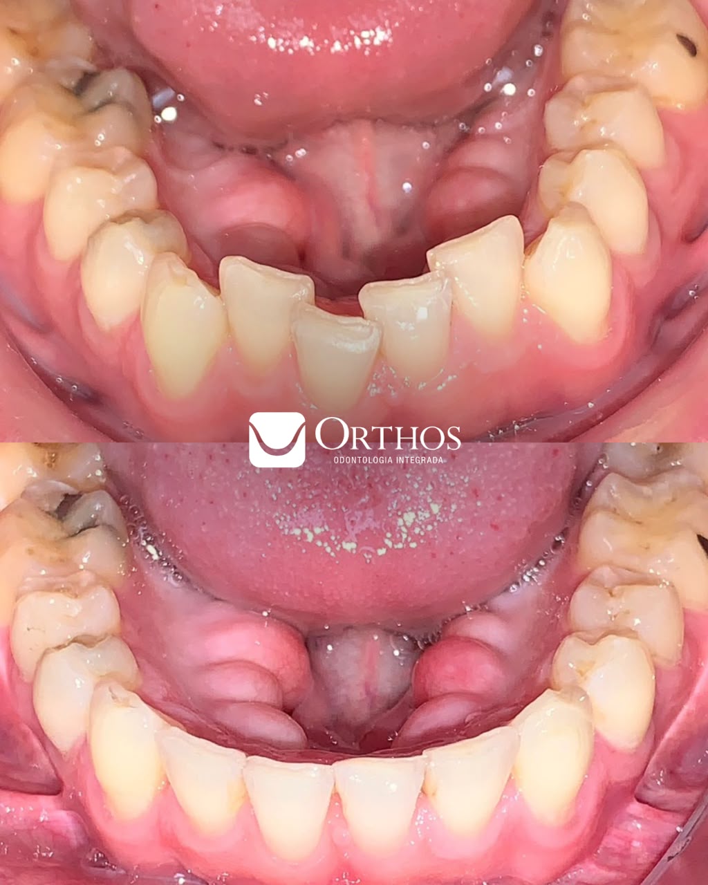 Alinhamento de Mordida com Invisalign.
